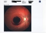 bloodeye2.jpg